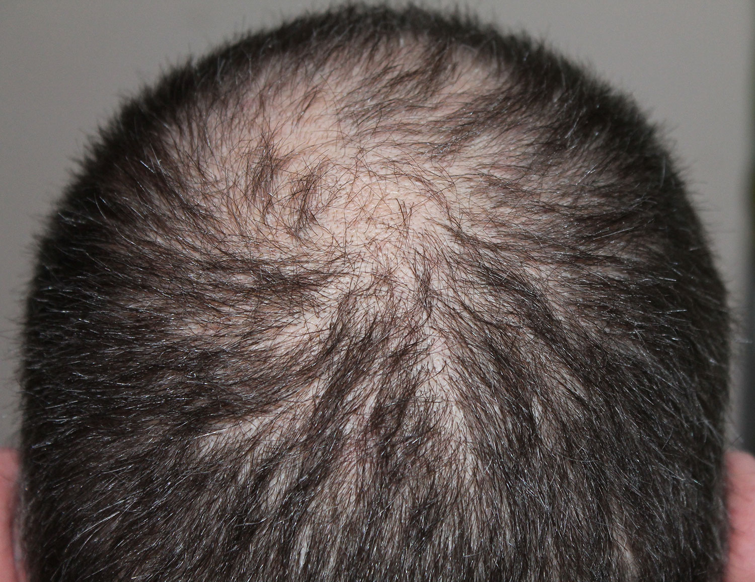 Chute de cheveux : quand consulter&nbsp;?