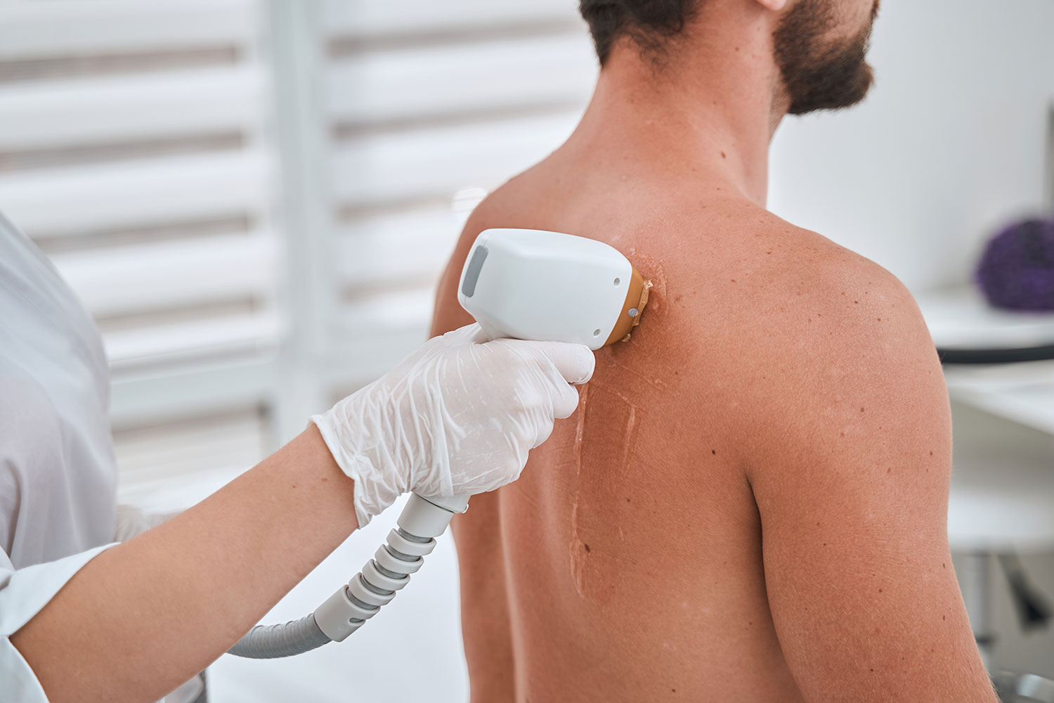 Épilation laser au masculin