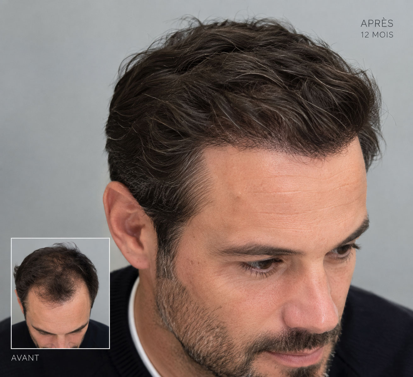 Greffe de cheveux Avant Après