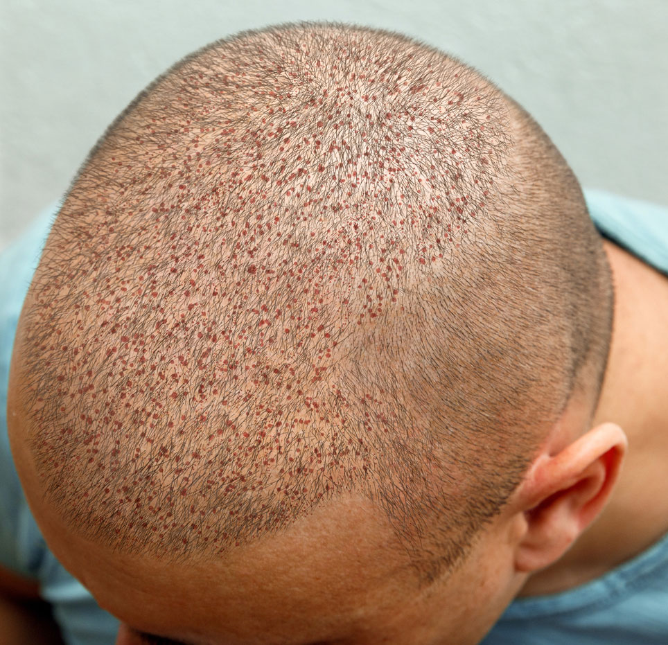 Greffe de cheveux