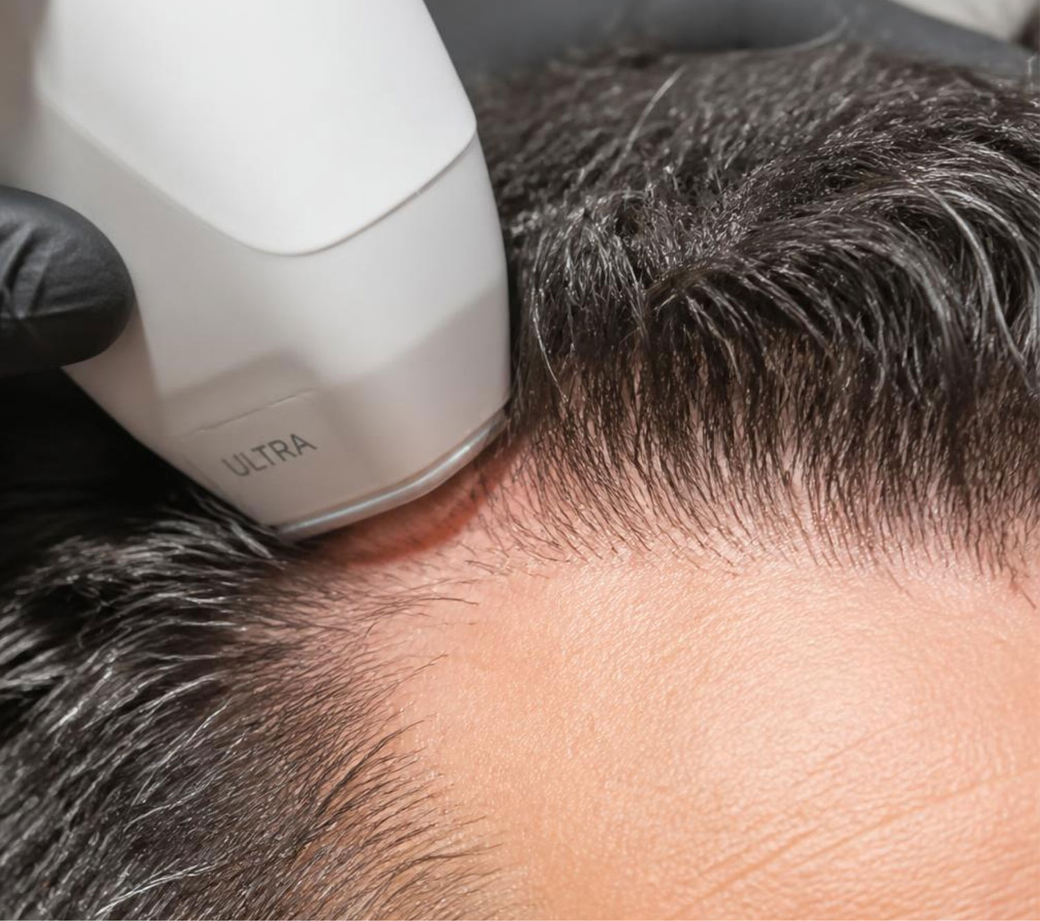 Stimulation capillaire par laser
