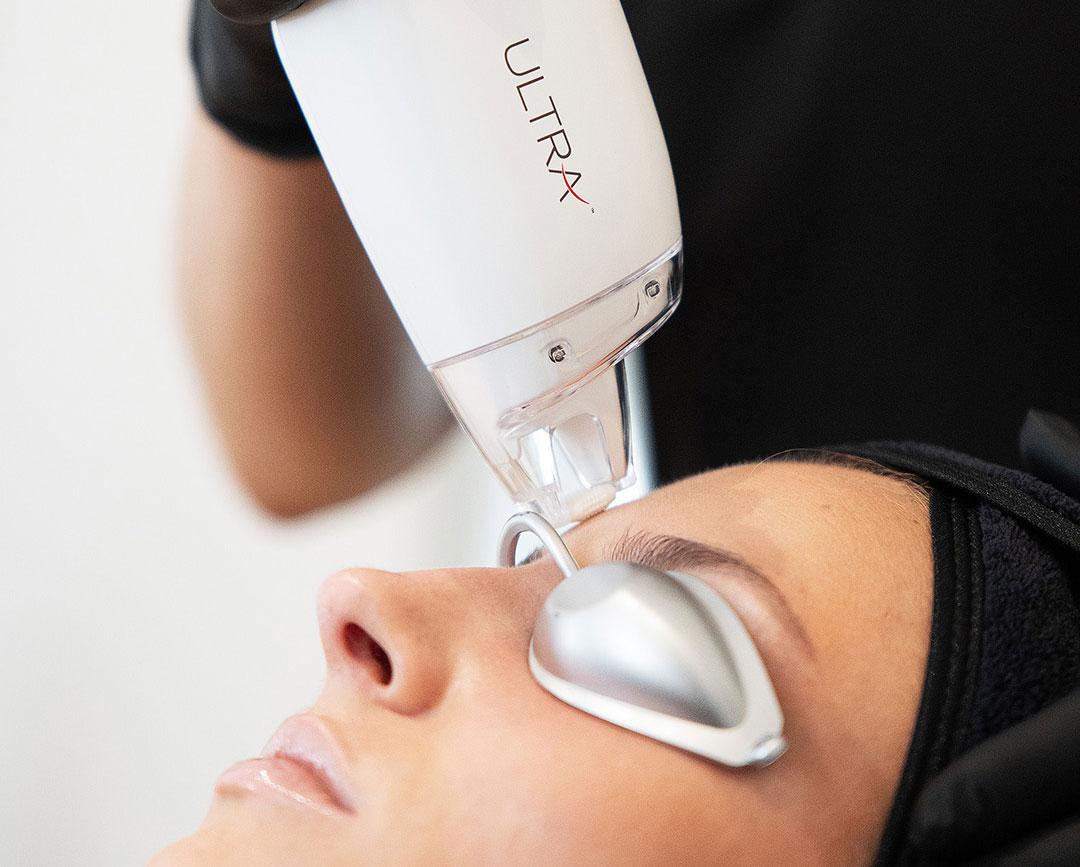 LaseMD Ultra visage Montpellier