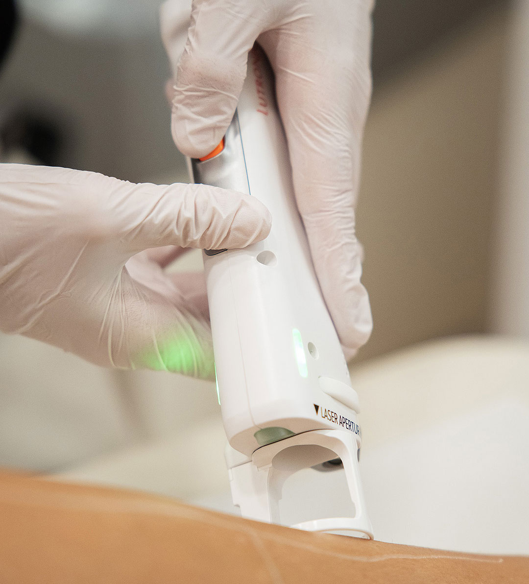 Laser dépilatoire