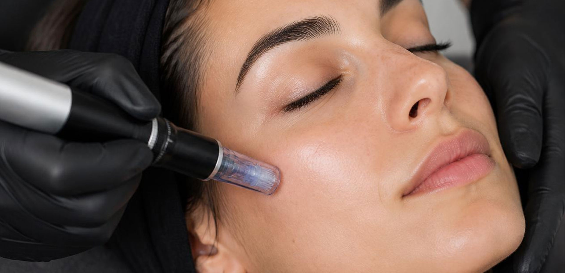 Microneedling à Montpellier