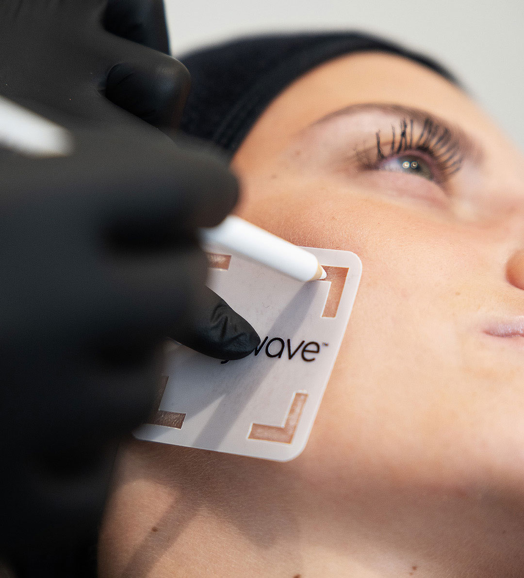 Sofwave raffermissement cutané