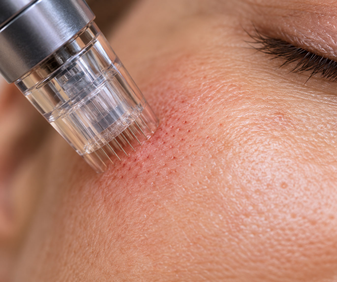 Microneedling visage Montpellier