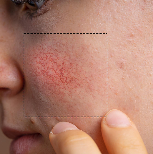 Rougeurs & troubles vasculaires